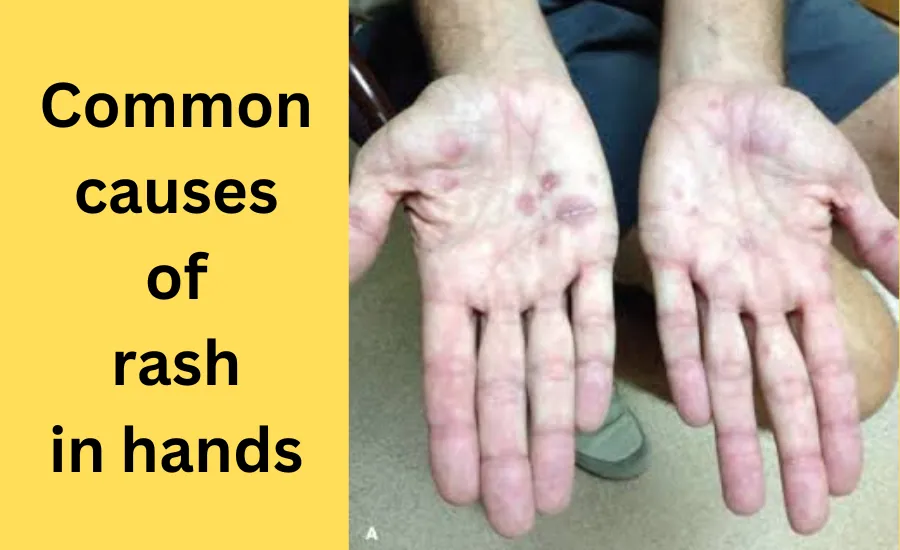 common causes of rash in hands
