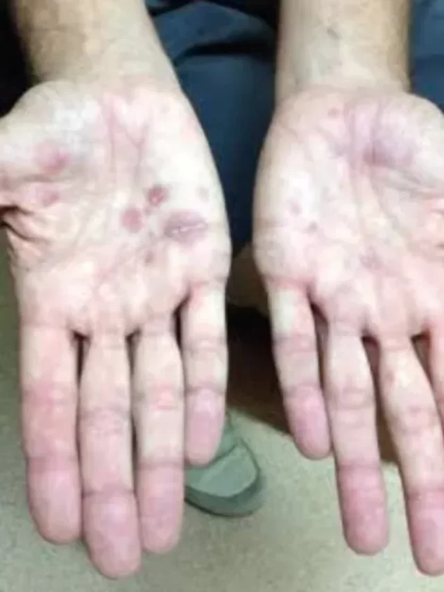 Conditions causing rash in hand